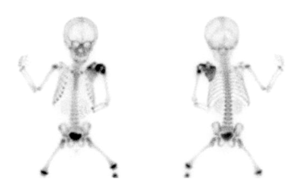 Figure 3 for case Myositis ossificans